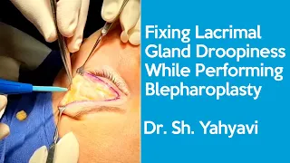 Fixing Lacrimal Gland Droopiness While Performing Blepharoplasty