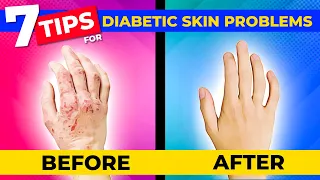 7 Tips To Avoid The Common Skin Problems Caused By Diabetes
