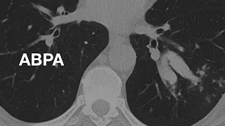 Classic Case: ABPA