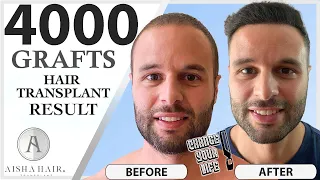 High Density and High Quality Hair Transplant | Injerto Capilar Alta Densidad y Alta Calidad |TURKEY