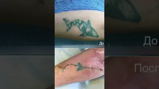 Хирургическое удаление тату ⚕️полное видео у нас на канале ☝🏽 #тату #лазерноеудаление #татуировка