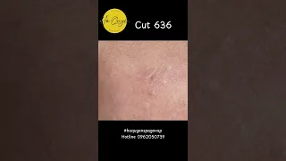 Cut 636 Hidden acne of a handsome men ep4 23/03/2024