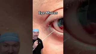 Eye Mucus Strings are Real! 😱 #shorts