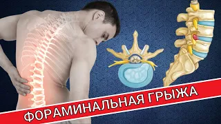 ФОРАМИНАЛЬНАЯ ГРЫЖА ПОЗВОНОЧНИКА. ЧТО ЭТО? КАК ЛЕЧИТЬ?