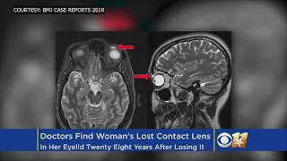 Doctors Find Woman's Contact Lens In Her Left Eyelid Twenty Eight Years After Losing It