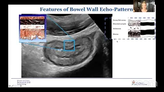 Bowel Ultrasound in Inflammatory bowel disease Session on Bowel Ultrasound