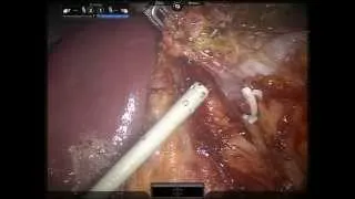 Nefrectomia Robotica in Marfan- Robotic Assisted left Nefrectomy in Marfan syndrome.-Dr Frongia
