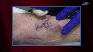 WCW: Follow Up - Treating a Forearm Wound with Prisma and OxyBand