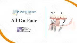 All on Four Los Algodones - Dental Tourism Mexico