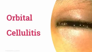 Orbital cellulitis