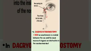DCR - Dacrocystorhinostomy  #ophthalmology