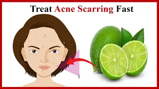 Some Effective Ways To Treat Acne Scarring (Health Tips)