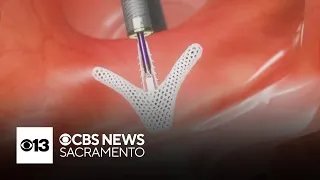 UC Davis one of first U.S. medical facilities to use new tool to avoid open heart surgery