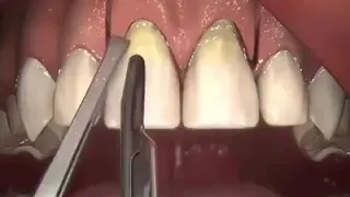 Diş Eti Ameliyatı