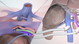 Malignant pheochromocytoma resection | TVASurg