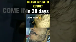 I used minoxidil for 4 month | Get best beard results #beard #shorts