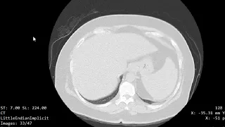 CASE 1095 CT CHEST PNEUMONITIS