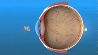 Presbyopia