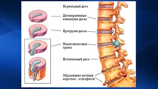 2.10. Массаж при дегенеративно-дистрофических заболеваниях позвоночника | Медицинский массаж. Цикл 2