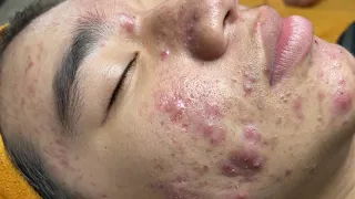 Satisfying Ando Relaxation with NaSa Beauty Spa #5 black point and acne extraction
