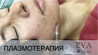 Плазмотерапия Плазмолифтинг лица и шеи