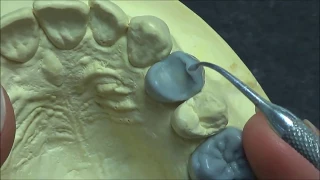 Live wax up - Upper 1st premolar(full)