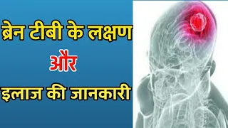 ब्रेन टीबी के लक्षण और इलाज कैसे संभव है? | Brain TB ke lakshan Aur Ilaj kya hai | Tb Ke Lakshan