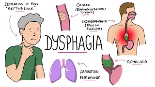 Dysphagia - Oropharyngeal & Esophageal Dysphagia (Causes/Differential Diagnosis, Signs, Treatment)