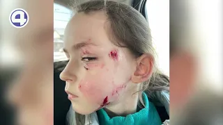 6-летнюю девочку покусала за лицо собака во время экскурсии