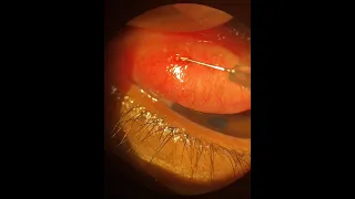 Management of Conjunctival Concretions: