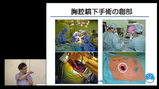 【Japan Cancer Forum2018】肺がん ～肺がんの外科治療・薬物療法～