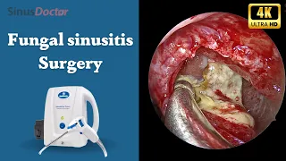 Revolutionary Fungal sinusitis surgery with Hydrodebrider  | Dr. Chaitanya Rao