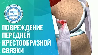 ❌​ Повреждение передней крестообразной связки и нестабильность суставов