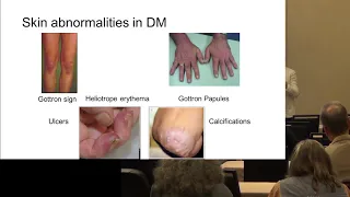Diagnosing Myositis, Marianne de Visser, MD