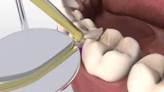 Posterior Composite with V3 Sectional Matrix System (Voice-Over)