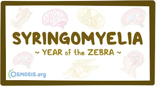 Syringomyelia (Year of the Zebra)