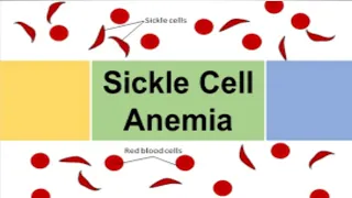 Sickle Cell Anemia | Causes | Types | Symptoms | Diagnosis | Treatment