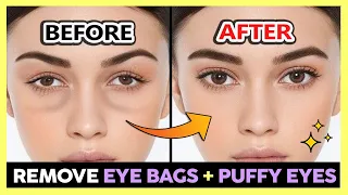 ✨ REMOVE UNDER EYE BAGS, PUFFY EYES, SWOLLEN EYES PERMANENTLY | GET BRIGHT EYES & BEAUTIFUL EYES