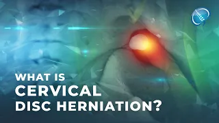 What is Cervical Disc Herniation? | Herniated Disc