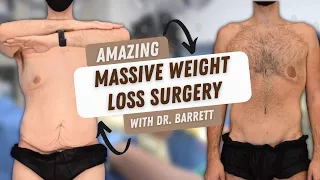 Massive Weight Loss Surgery - Mid Thoracic Lift, Extended Medial Thigh Lift, & Suprapubic Lift