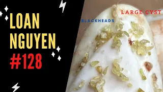 Large cysts and blackhead removal (128) | Loan Nguyen