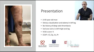 Chronic venous insufficiency: endovenous RF ablation