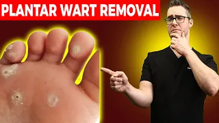 #1 BEST Plantar Wart Removal? [How To Get Rid of Warts Treatments]