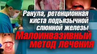 Ранула, ретенционная киста подъязычной слюнной железы  Малоинвазивный метод лечения