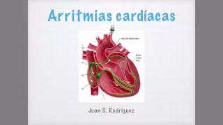 Arritmias cardíacas en el EKG