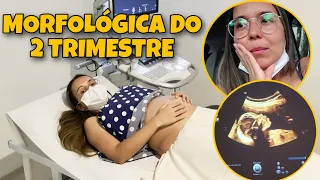 ULTRASSOM MORFOLÓGICA DO SEGUNDO TRIMESTRE - 21 SEMANAS