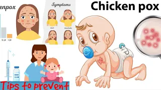 Chicken Pox for Babies in tamil||How it spread and prevention for chicken pox?||When will it cure?