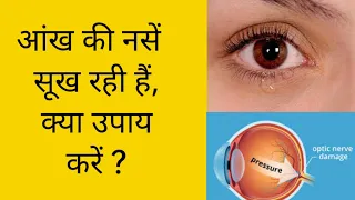 आंख की नसें सूख रही हैं क्या उपाय करें/ आंख की नसें सूखने पर क्या उपाय करें/ Optic atrophy/ Glaucoma