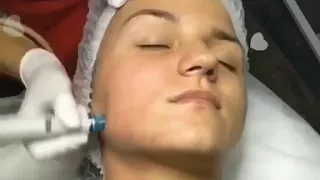 Hydra facial- cosmetologist_anita_pavlishko, Вакумная Чистка лица, глубокое увлажнение