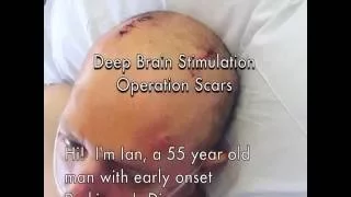 Deep Brain Stimulation (DBS) Operation Scars